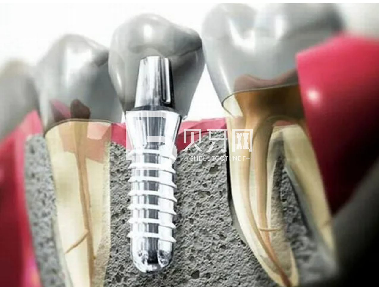 種植牙，真的很可怕嗎？