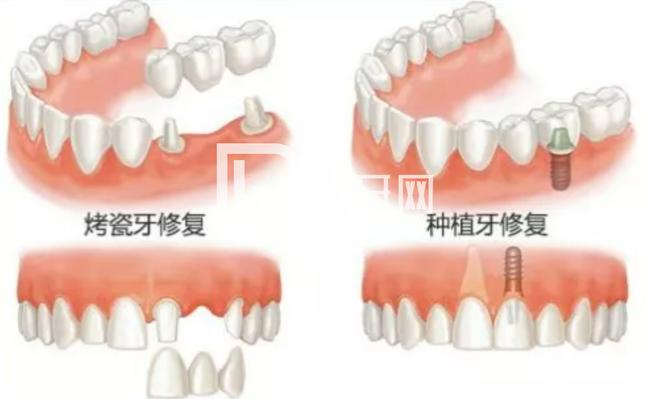 老人種牙對身體條件有要求嗎？