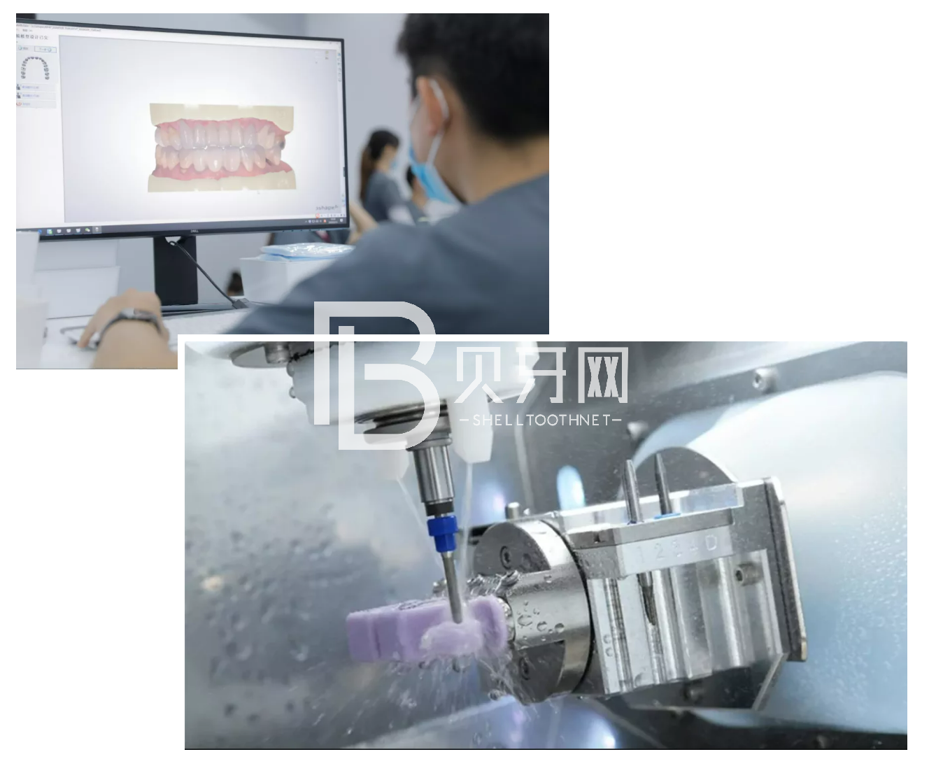 缺牙后最容易陷入的誤區(qū)，您中招了嗎？