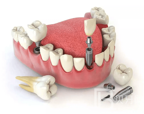 不到60歲，牙齒就所剩無(wú)幾了？這5件護(hù)牙小事，別等老了再做！