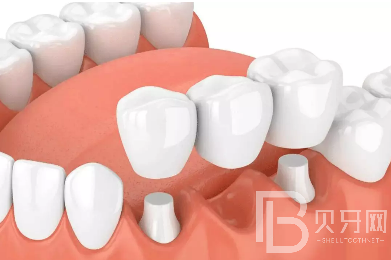 牙齒缺失會(huì)折壽10年？缺牙的后果比你想象的嚴(yán)重