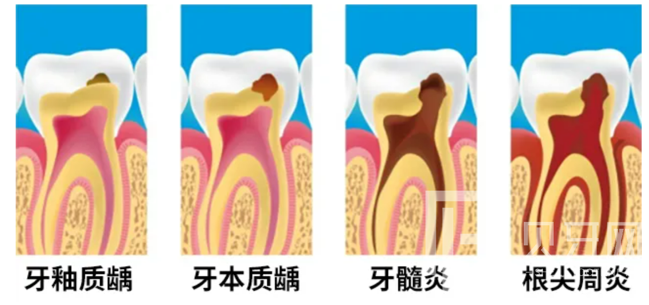牙疼到無法入睡，我們該怎么辦？