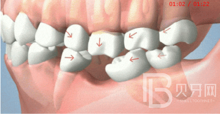 90%不知道，牙齒缺失后，盡然會出現(xiàn)這些癥狀！