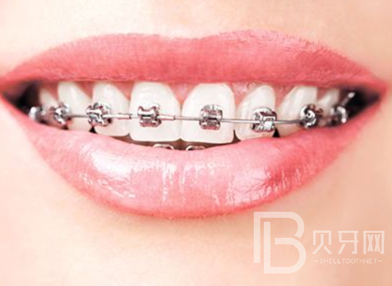 牙齒矯正有風險嗎？來聽聽口腔醫(yī)生怎么說