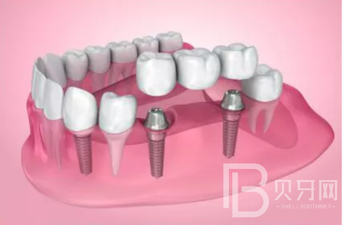 拔牙后一般多久能做種植牙？選什么植體比較好？