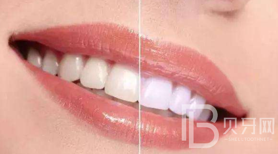 影響牙齒美白的六大食物，你知道是哪六種嗎？