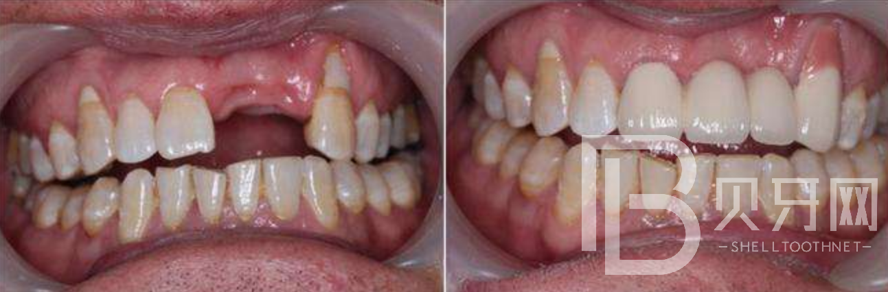 有牙周炎能不能做種植牙？