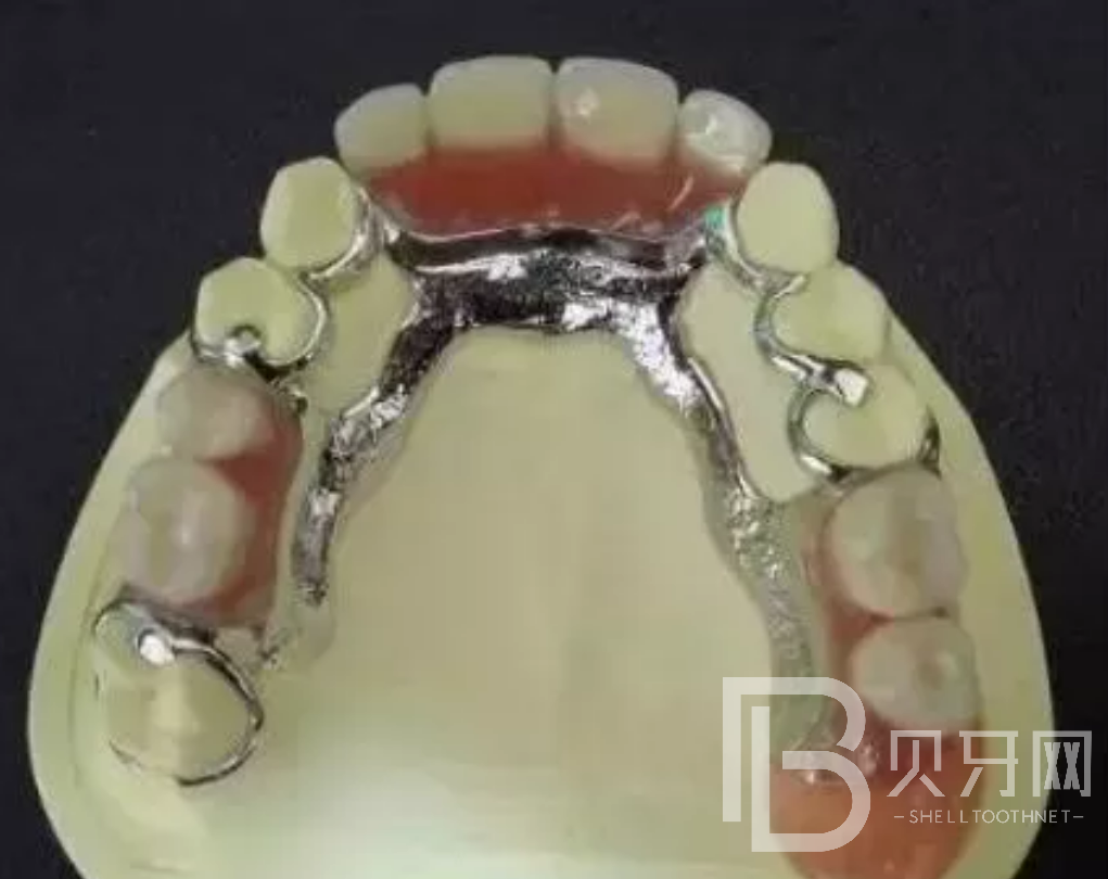 牙齒缺失一顆哪種修復(fù)方式好？