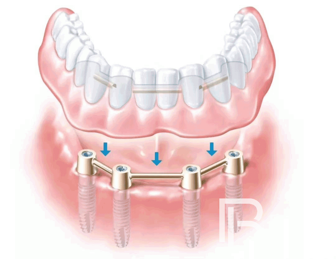 種植牙知識(shí)科普：All-on-4種植牙的幾個(gè)常見問題！