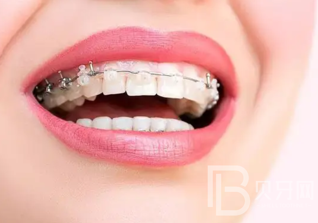 隱形牙套、鋼托槽、陶瓷托槽有什么區(qū)別？