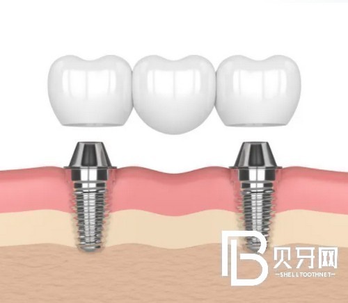 上海種植牙多少錢一顆？種植牙齒哪里比較好？