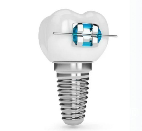 若問上?？梢苑N牙嗎?哪家醫(yī)院好?哪里便宜?得認(rèn)準(zhǔn)這幾家!