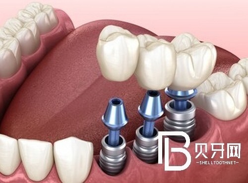 北京荷馬口腔看牙很貴嗎？醫(yī)院價格表告訴你實情！