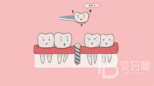 上海華齒口腔做牙收費貴嗎？看看診療價格這幾項很便宜！