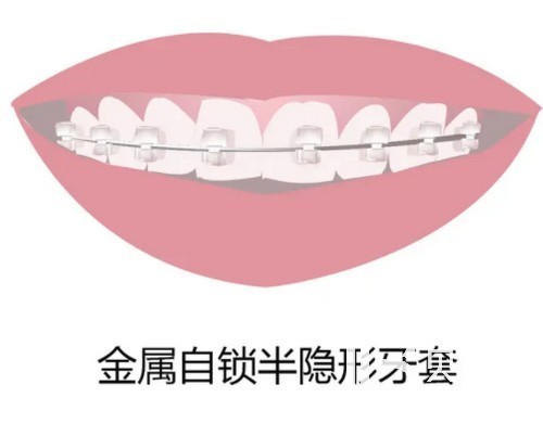 上海牙齒矯正價(jià)格表揭秘 五千到五萬都有就看你怎么選擇！