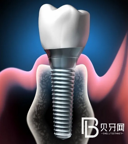 北京種植牙的價格表公布：看看在北京種牙哪里便宜！