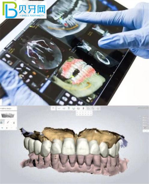 美奧口腔種植牙技術(shù)怎么樣 徐州的單顆半口都多少錢(qián)？