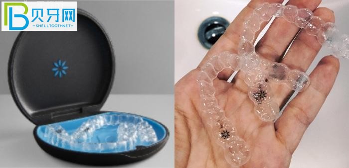 珠海隱形牙套哪家醫(yī)院比較好?推薦暨博口腔技術好價不高!