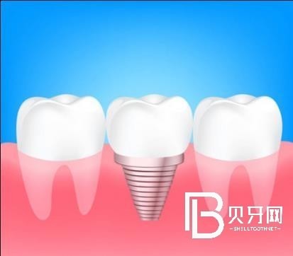 上海雅潔口腔怎么樣？種植牙多少錢？