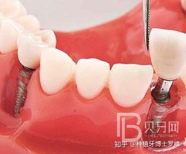 種植牙怎么樣？看看深圳諾德口腔怎么說！