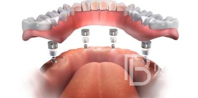 全口種植牙需要種幾棵？北京維樂口腔種植牙技術(shù)怎么樣？