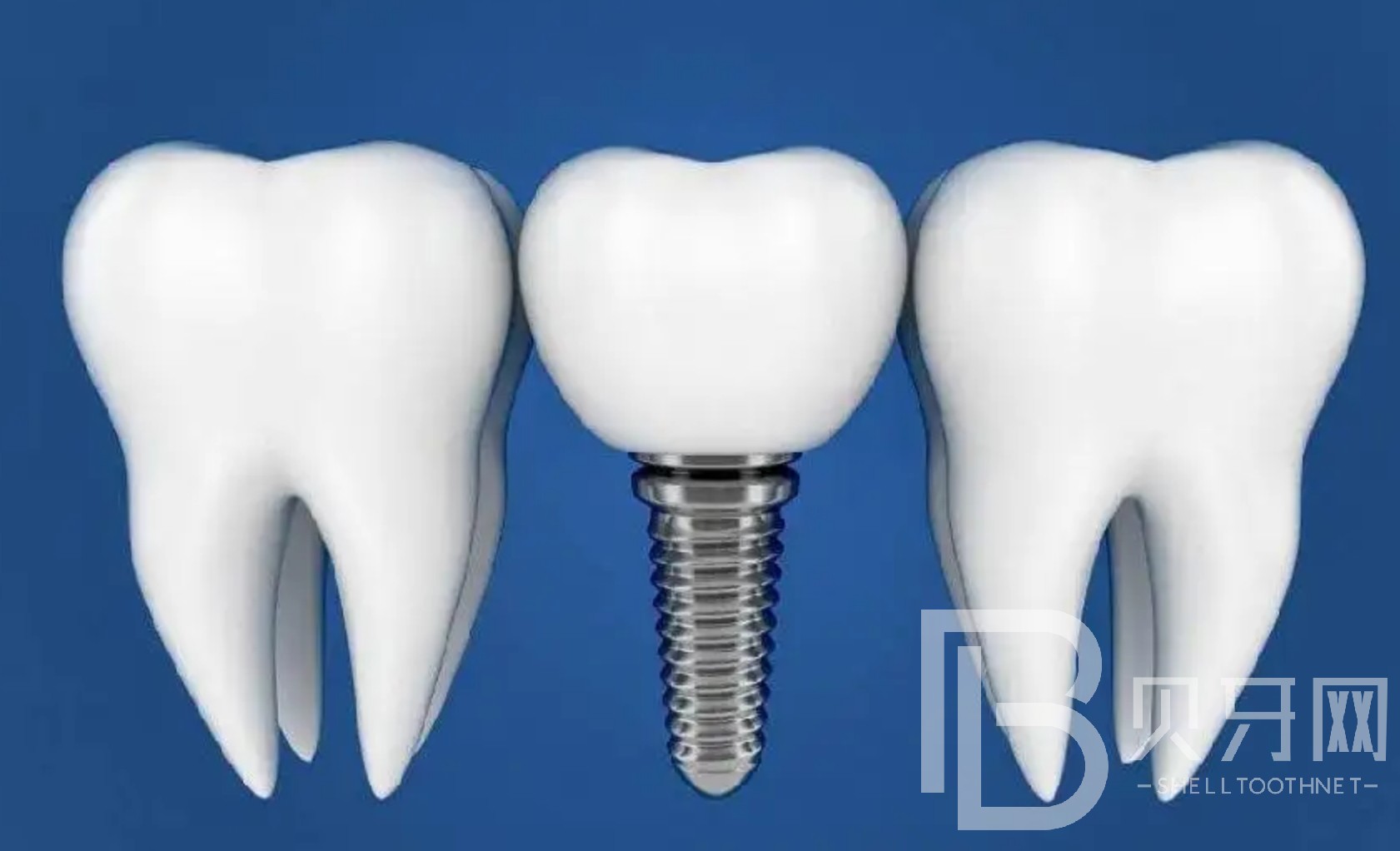 半口種植牙大概要幾次完成？北京美冠塔口腔種植牙怎么樣？