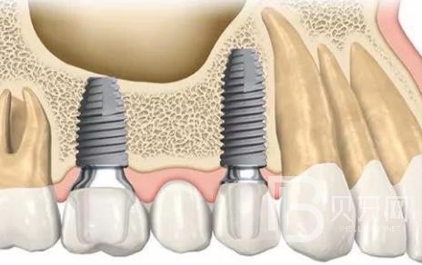 廣州瑞德口腔種植牙怎么樣？廣州瑞德口腔種植牙多少錢