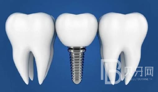 廣州瑞爾口腔老年人能做種植牙嗎？廣州瑞爾口腔價(jià)格多少錢(qián)