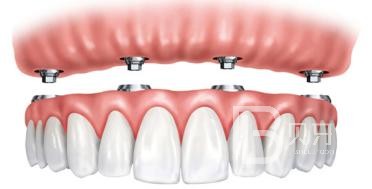 即刻種植牙好還是3月后種植好？北京德貝口腔種植牙怎么樣？