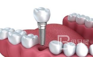 60歲老年人種植牙哪家好？北京鈦植口腔怎么樣？