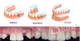 60歲的人種植牙還是鑲牙好？北京冠美口腔怎么樣？