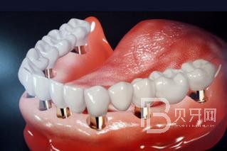 半口種植牙要種幾顆？北京維樂口腔正規(guī)嗎？