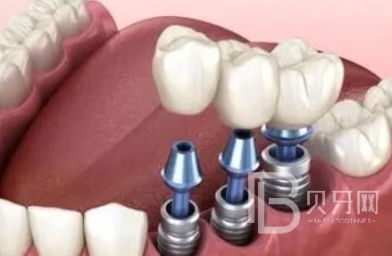 廣州諾爾口腔怎么樣？廣州諾爾口腔種植牙一顆多少錢