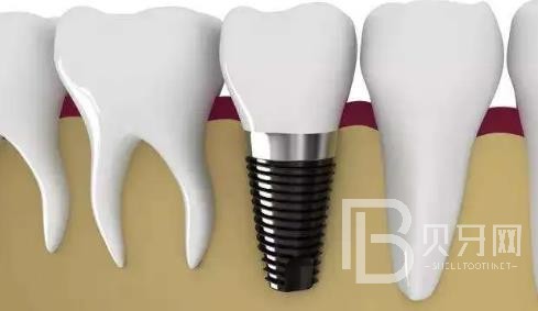 廣州曙光口腔正規(guī)靠譜嗎？醫(yī)院位置在哪？廣州曙光口腔種植牙價(jià)格