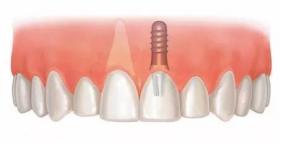 老年人適合的種植牙？北京諾美口腔怎么樣？