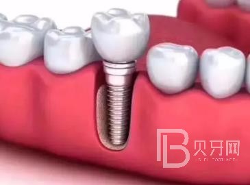 廣州研科口腔醫(yī)院怎么樣？廣州研科口腔口碑好不好？廣州研科口腔種植牙多少錢