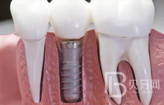 廣州柏德口腔怎么樣？廣州柏德口腔種植牙一顆多少錢(qián)