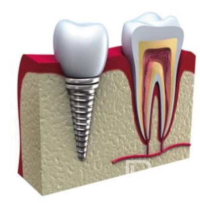 廣州德祥口腔怎么樣？廣州德祥口腔口碑好不好？廣州德祥口腔種植牙價(jià)格