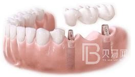 75歲老人適不適合做種植牙？北京圣貝口腔怎么樣？