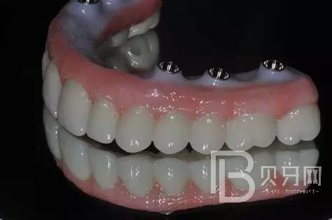 全口種植牙的利與弊都有哪些？北京拜博口腔正規(guī)嗎？