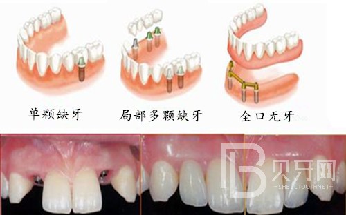 半口種植牙一般需要幾個階段？北京德貝口腔種植牙正規(guī)嗎？
