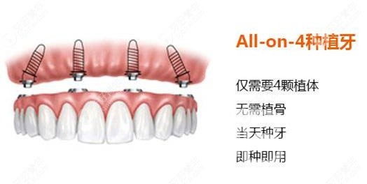 滿口種植牙需要種幾顆？北京佳美口腔正規(guī)嗎？