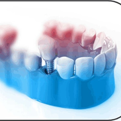 寧波種植牙價錢！寧波江北康樂口腔門診部種植牙價格被打下來了，國產(chǎn)常州創(chuàng)英種植牙：3873元起/顆！