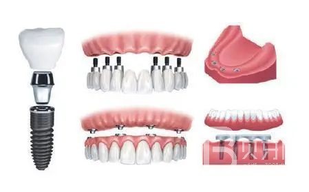 半口種植牙需要幾個(gè)種植體？北京牙管家口腔怎么樣？