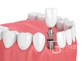 老年人適合種植牙么？北京薇琳口腔種植牙怎么樣？
