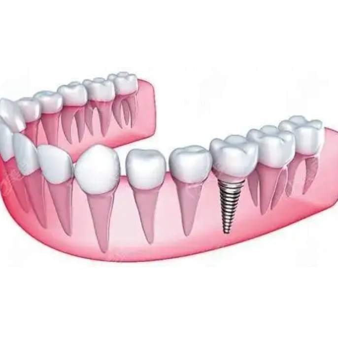 杭州種植一顆牙需多少錢！杭州聞喜淇杰口腔醫(yī)院(余杭古墩路口腔診所)種植牙價格表更新，德國Camlog種植體：6350元起/顆！