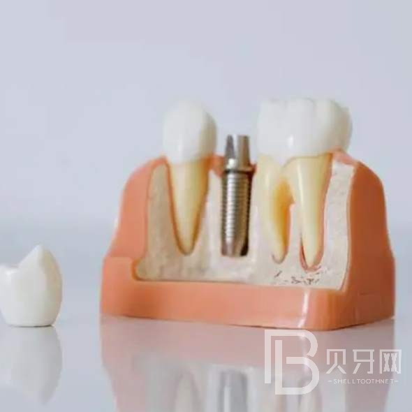 杭州一顆種植牙齒多少錢！杭州容勝口腔門診部種植牙收費表公布，瑞士iti：6013元起/顆！