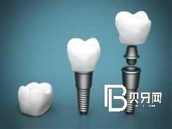 北京種植牙齒價格多少？含北京種植牙價格表！