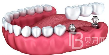 什么是半口種植牙？東莞國貿(mào)口腔來回答