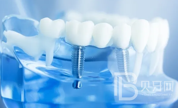 東莞牙博士口腔可以做種植牙嗎？